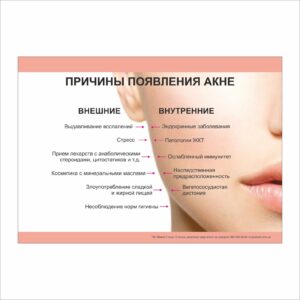 Плакат “Причины появления акне” в медичний кабінет