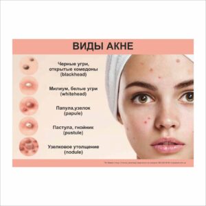Плакат “Виды акне” в медичний кабінет