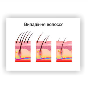 Плакат “Випадіння волосся”