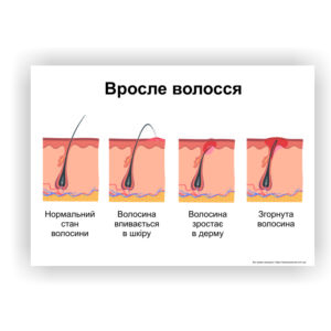 Плакат “Вросле волосся" в косметологічний кабінет