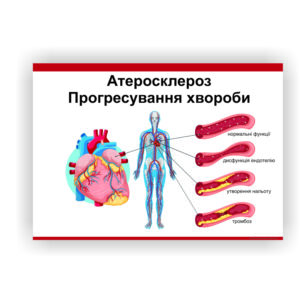 Плакат “Атеросклероз” в медичний кабінет