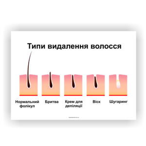 Плакат “Типи видалення волосся”