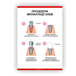 Плакат “Процедура імплантації зубів” в медичний кабінет