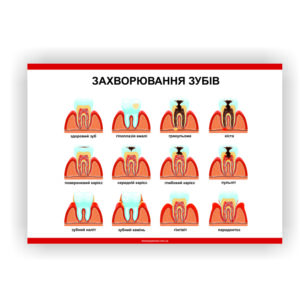 Плакат “Захворювання зубів” в медичний кабінет
