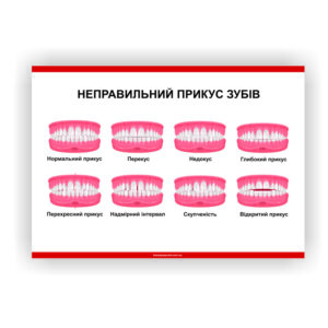 Плакат “Неправильний прикус зубів” в медичний кабінет