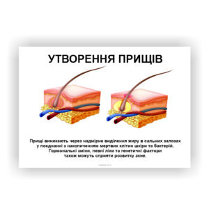 Плакат “Утворення прищів”