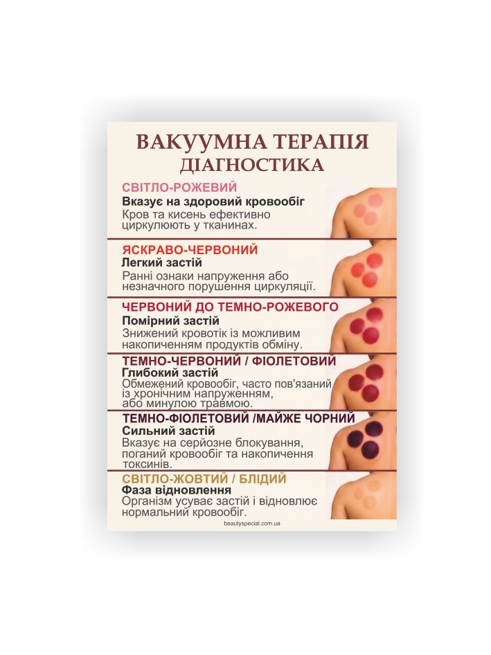 Плакат “Вакуумна терапія”